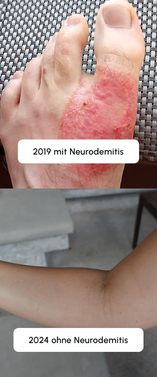 Neurodermitis Selbstheilung Für Selbstbetroffene Vincent 2